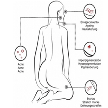 Beneficios del Acido Glicólico de Mesoterapia BCN . Hiperpigmentation treatment.