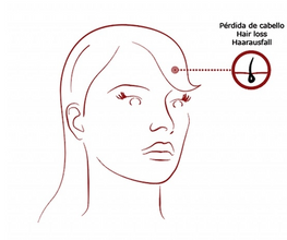 Silueta de mujer que indica donde aplicar Mesoterapia para caída del cabello de Institute BCN